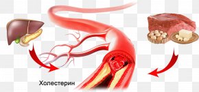 Blood - Cholesterol Disease Stroke Medicine Intermittent Claudication PNG