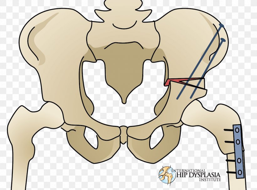 Osteotomy Hip Dysplasia Surgery Therapy, PNG, 1183x875px, Watercolor, Cartoon, Flower, Frame, Heart Download Free