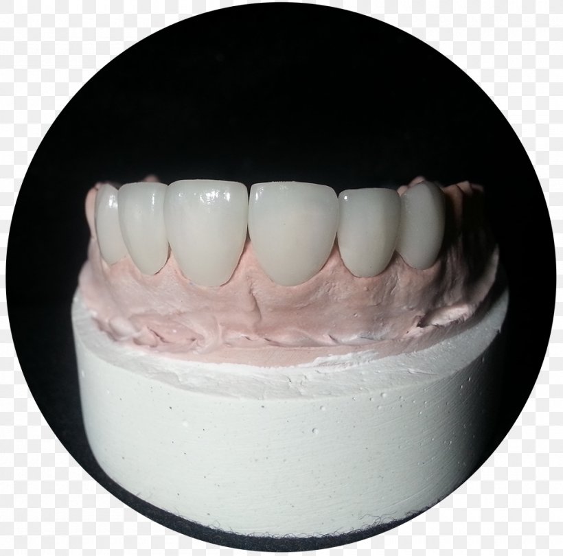 Viax Dental Panamá Glass-ceramic Technology, PNG, 1000x989px, Ceramic, Aesthetics, Computeraided Manufacturing, Dentistry, Employee Benefits Download Free