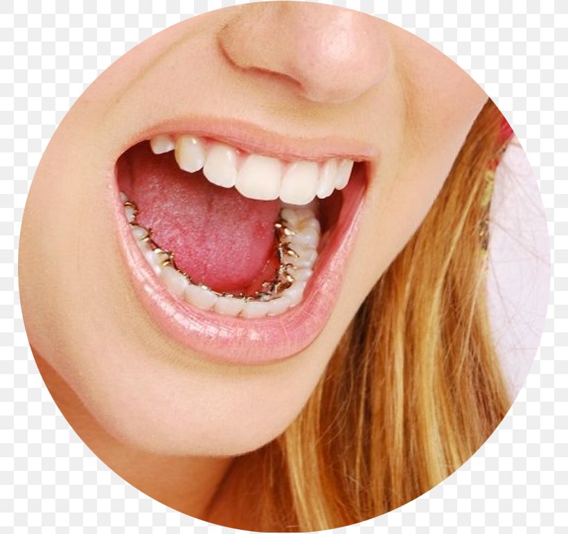 Castleknock Orthodontics Dental Braces Lingual Braces Clear Aligners, PNG, 771x771px, Dental Braces, Cheek, Chin, Clear Aligners, Close Up Download Free