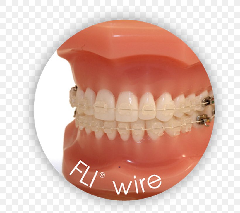 Nickel Titanium Orthodontic Archwire, PNG, 728x728px, Nickel Titanium, Alloy, Copper, Copper Conductor, Cupronickel Download Free