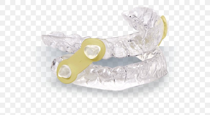 Mandibular Advancement Splint Mandible Dentistry Snoring Jaw, PNG, 600x448px, Mandibular Advancement Splint, Apnea, Continuous Positive Airway Pressure, Crystal, Dentist Download Free