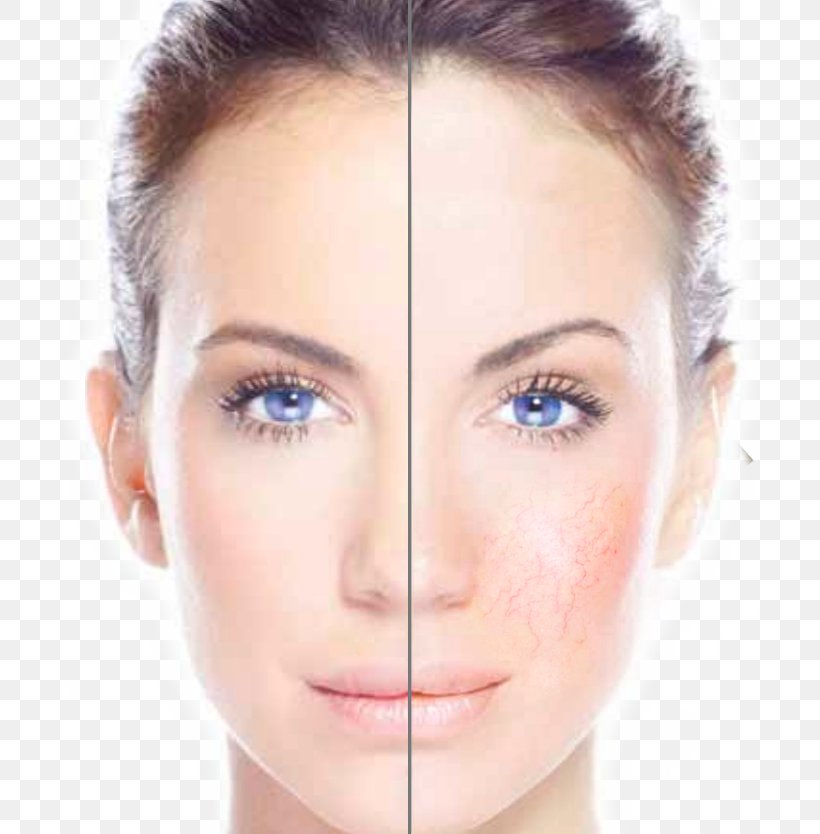 Freckle Laser Hair Removal Laser Hair Removal Hyperpigmentation, PNG, 700x834px, Freckle, Acne, Beauty, Cheek, Chin Download Free