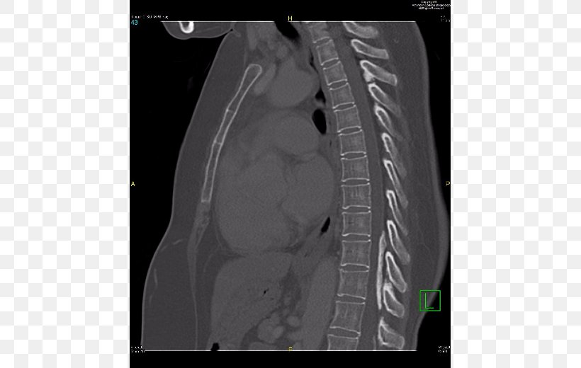 Radiology Autosomal Dominant Polycystic Kidney Disease Radiopaedia Medical Diagnosis, PNG, 550x520px, Radiology, Auto Part, Automotive Tire, Automotive Wheel System, Black And White Download Free