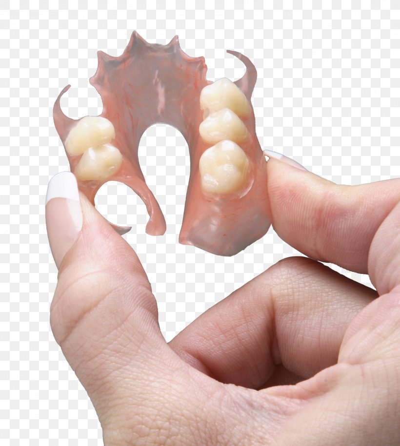 Dentures Dental Laboratory Dentistry Removable Partial Denture, PNG, 1602x1788px, Dentures, Ceramic, Dental Braces, Dental Implant, Dental Laboratory Download Free