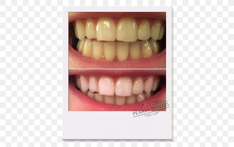 Tooth Whitening Dentistry Human Tooth, PNG, 517x517px, Tooth, Cosmetic Dentistry, Dental Restoration, Dentist, Dentistry Download Free