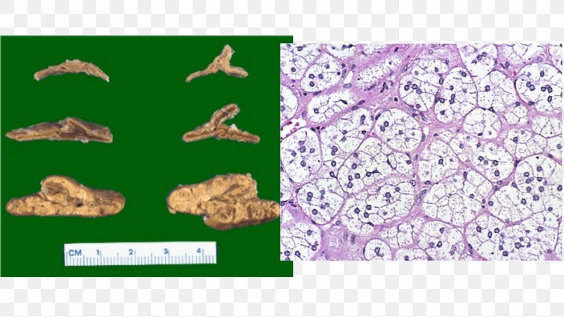 Thyroid Nodule Adrenal Gland Hyperplasia, PNG, 960x540px, Thyroid, Adrenal Gland, Adrenal Gland Disorder, Fauna, Follicular Thyroid Cancer Download Free