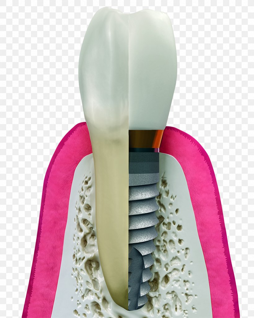 Dental Implant Dentistry Surgery, PNG, 960x1200px, Dental Implant, Bridge, Crown, Dental Extraction, Dental Surgery Download Free