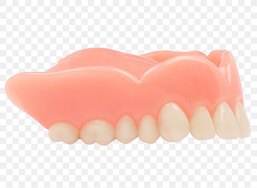 Dentures Tooth Dentistry Gums Removable Partial Denture, PNG, 800x601px, Dentures, Aspen Dental, Dental Abscess, Dental Emergency, Dentistry Download Free