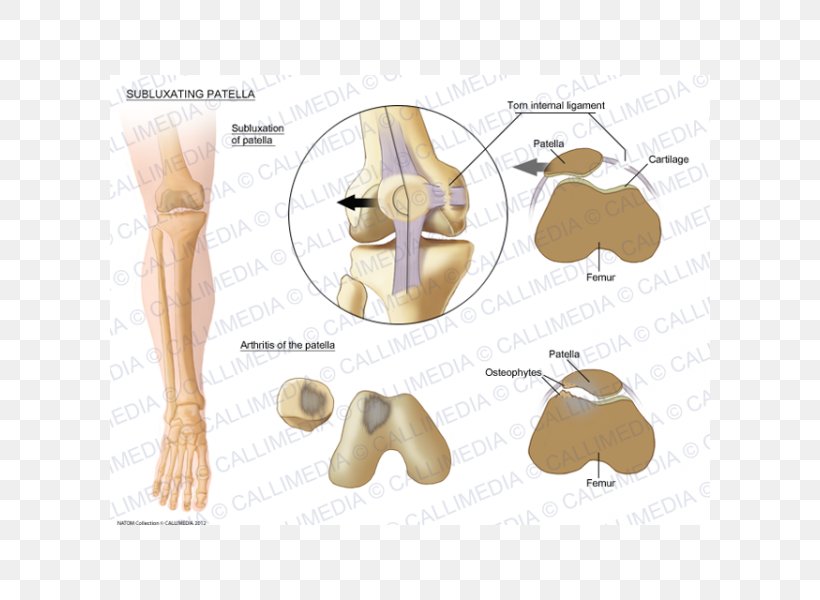 Patella Subluxation Bone Shoulder Pulled Elbow, PNG, 600x600px, Watercolor, Cartoon, Flower, Frame, Heart Download Free