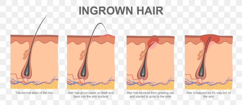 Ingrown Hair Hair Removal Electrolysis Waxing, PNG, 3277x1425px, Ingrown Hair, Brand, Electrolysis, Eyebrow, Hair Download Free