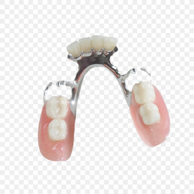 Tooth Dentures Prosthesis Removable Partial Denture Dentistry, PNG, 1020x1020px, Tooth, Body Jewelry, Cosmetic Dentistry, Crown, Dental Implant Download Free