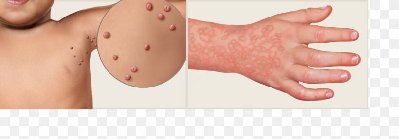 Exanthem Skin Rash Virus Morbilliform Fifth Disease, PNG, 848x296px, Watercolor, Cartoon, Flower, Frame, Heart Download Free