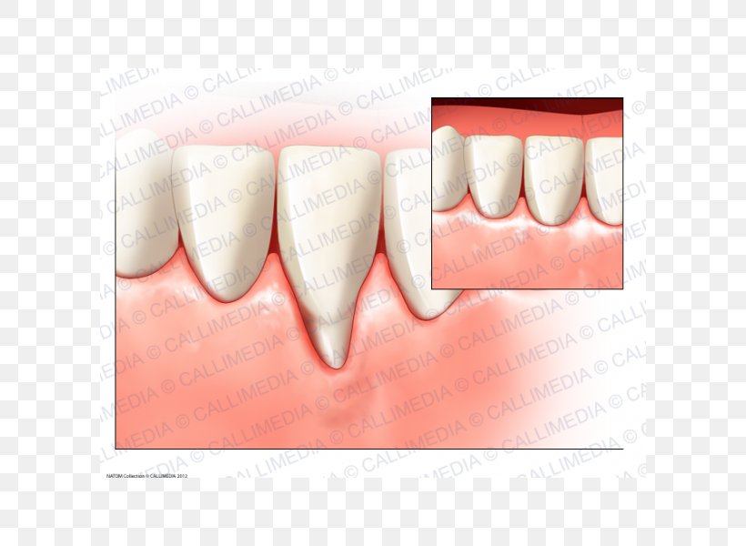 Tooth Gums Surgery Periodontal Disease Gingival Recession, PNG, 600x600px, Tooth, Dental Implant, Dentist, Dentistry, Gingival Graft Download Free