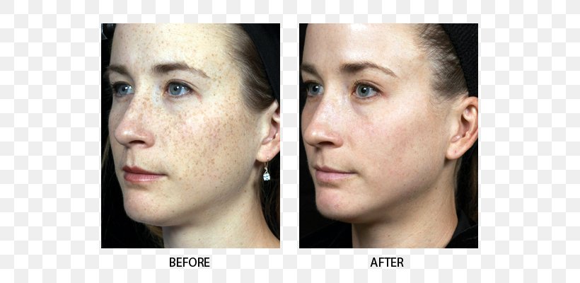 Fraxel Photorejuvenation Laser Dermatology Hair Removal, PNG, 640x400px, Fraxel, Aesthetic Medicine, Cheek, Chin, Dermatology Download Free