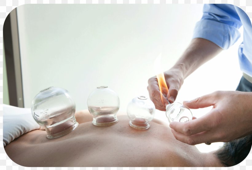 Medicine Cupping Therapy Hijama Health Care, PNG, 1024x692px, Medicine, Acupuncture, Body, Chinese Herbology, Cupping Therapy Download Free