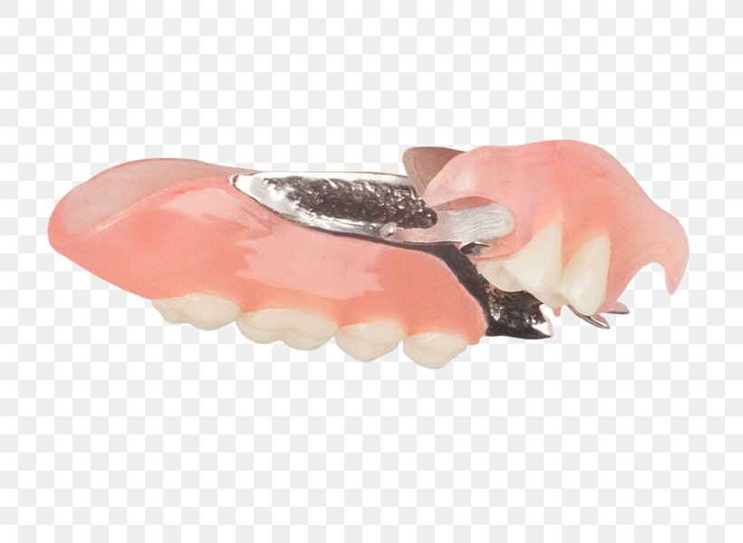 Removable Partial Denture Dentures Mouth Dentistry Tooth, PNG, 749x600px, Removable Partial Denture, Aspen Dental, Dentistry, Dentures, Digital Media Download Free