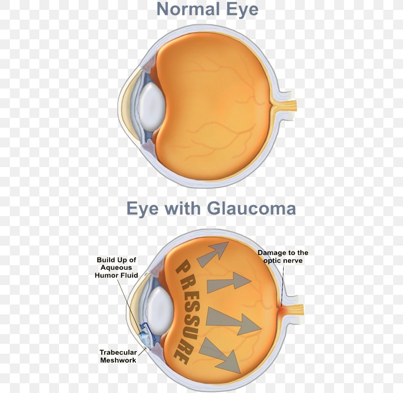Glaucoma Human Eye Eye Care Professional Optic Nerve, PNG, 450x800px, Glaucoma, Disease, Ear, Eye, Eye Care Professional Download Free