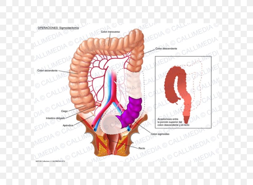 Colorectal Cancer Surgery Colon Large Intestine, PNG, 600x600px, Watercolor, Cartoon, Flower, Frame, Heart Download Free
