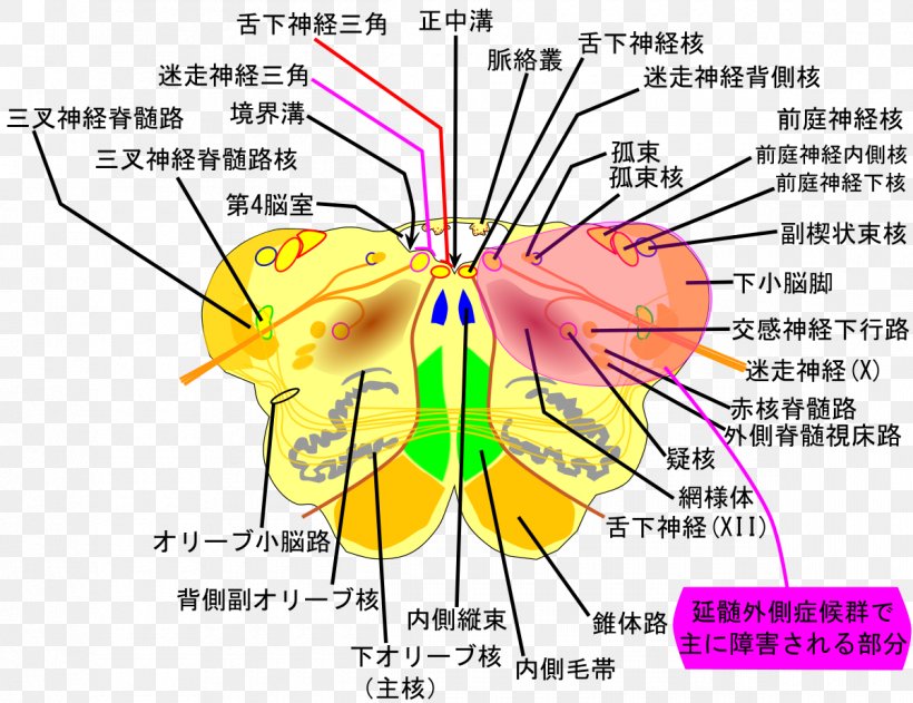 Lateral Medullary Syndrome Medulla Oblongata Posterior Inferior Cerebellar Artery Cerebellum, PNG, 1200x924px, Watercolor, Cartoon, Flower, Frame, Heart Download Free