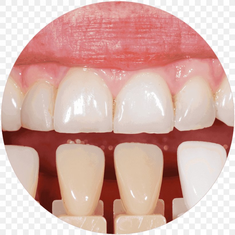 Tooth Whitening Cosmetic Dentistry Veneer, PNG, 1260x1260px, Tooth Whitening, Bridge, Cosmetic Dentistry, Crown, Dental Implant Download Free