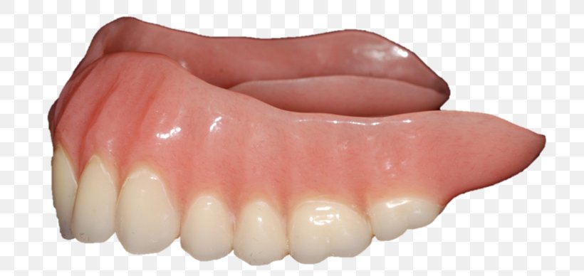 Dentures Human Tooth, PNG, 748x388px, Dentures, Human Tooth, Jaw, Lip, Mouth Download Free