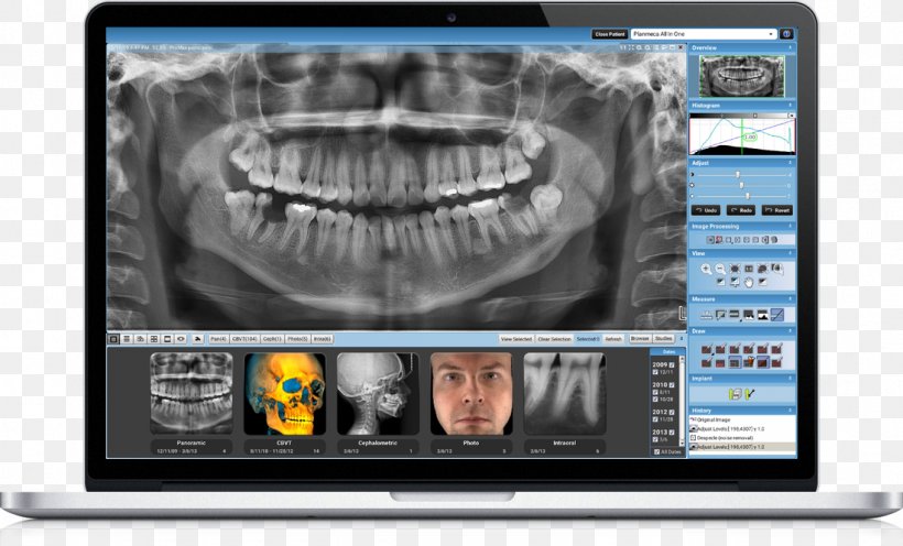 Dentistry Medicine Medical Imaging Dental Radiography Computer Monitors, PNG, 1099x665px, Dentistry, Aparat Rentgenowski, Cephalometry, Computed Tomography, Computer Monitors Download Free