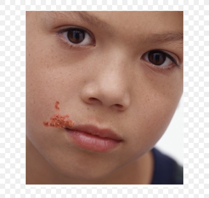 Impetigo Herpes Labialis Skin Infection Cutaneous Condition, PNG, 620x776px, Impetigo, Blister, Boil, Cheek, Child Download Free