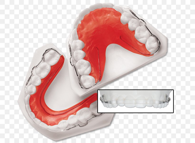Tooth Retainer Orthodontics Dentistry Dental Braces, PNG, 679x600px, Tooth, Dental Braces, Dentistry, Electrical Wires Cable, Finger Download Free