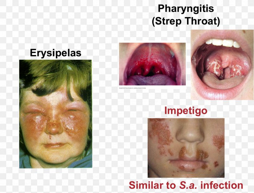 Lip Cheek Streptococcal Pharyngitis Chin Tonsillitis, PNG, 1427x1087px, Lip, Cheek, Chin, Close Up, Closeup Download Free