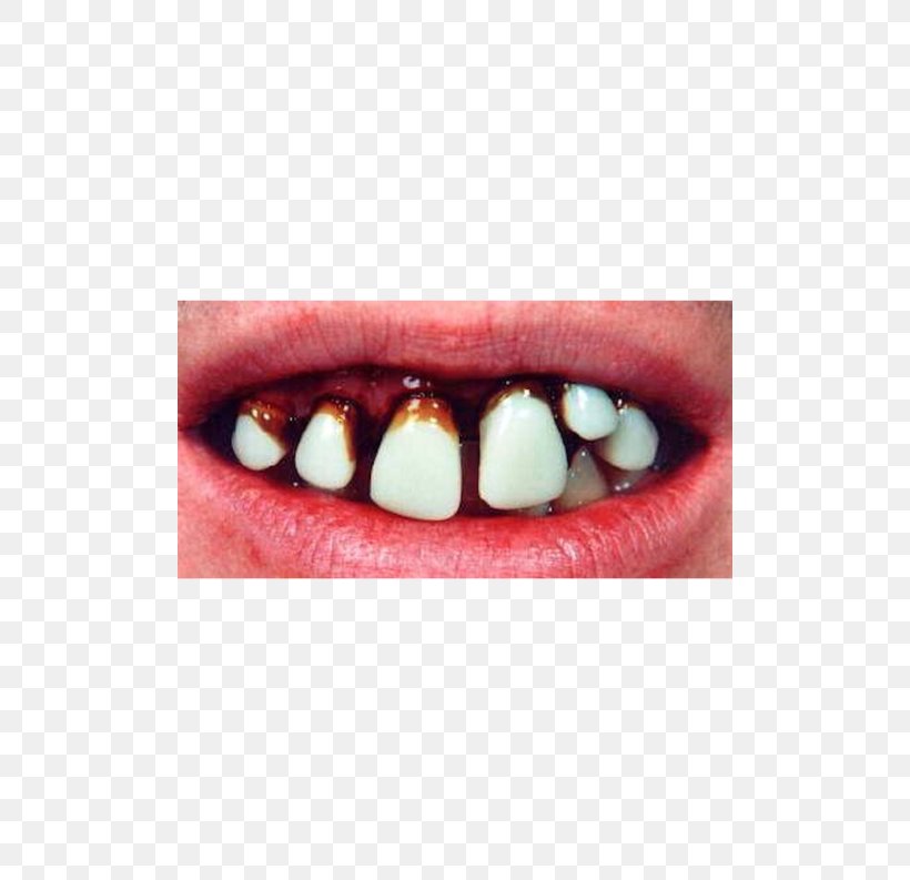 Human Tooth Dentures EBay Hillbilly, PNG, 500x793px, Human Tooth, Cosmetic Dentistry, Dentures, Ebay, Hillbilly Download Free