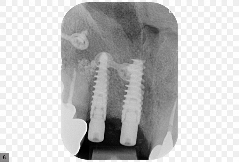 Dental Implant Jaw Soft Tissue Radiography, PNG, 1072x730px, Dental Implant, Black And White, Finger, Hand, Implant Download Free