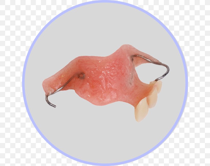 Durant Dentures Removable Partial Denture Human Tooth Dentistry, PNG, 649x650px, Durant, Bridge, Cosmetic Dentistry, Dental Implant, Dentist Download Free