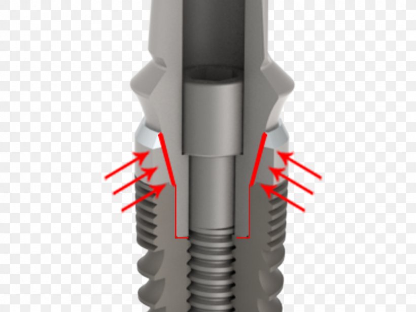 Dental Implant Abutment Dentistry Tooth, PNG, 1024x768px, Dental Implant, Abutment, Bone, Cone, Cylinder Download Free