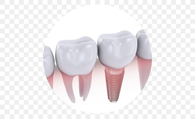 Dental Implant Dentistry Dentures Crown, PNG, 500x500px, Watercolor, Cartoon, Flower, Frame, Heart Download Free