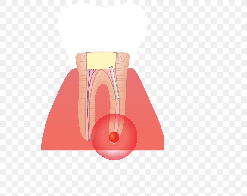 Root Canal Infection Tooth Poster, PNG, 562x650px, Root Canal, Bed, Com, Fourposter Bed, Infection Download Free