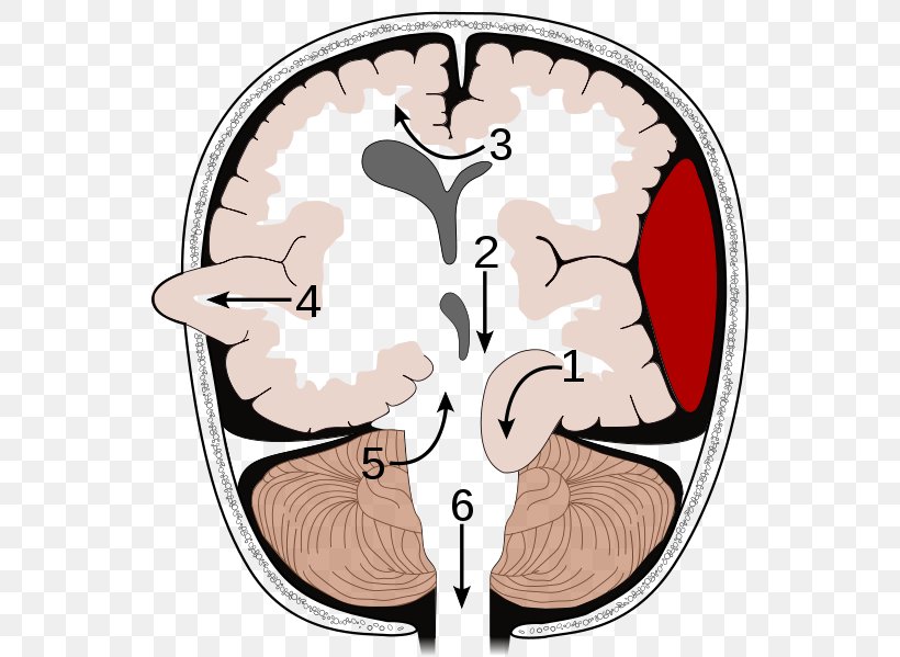 Brain Herniation Intracranial Pressure Traumatic Brain Injury Cerebellar Tentorium, PNG, 552x599px, Watercolor, Cartoon, Flower, Frame, Heart Download Free