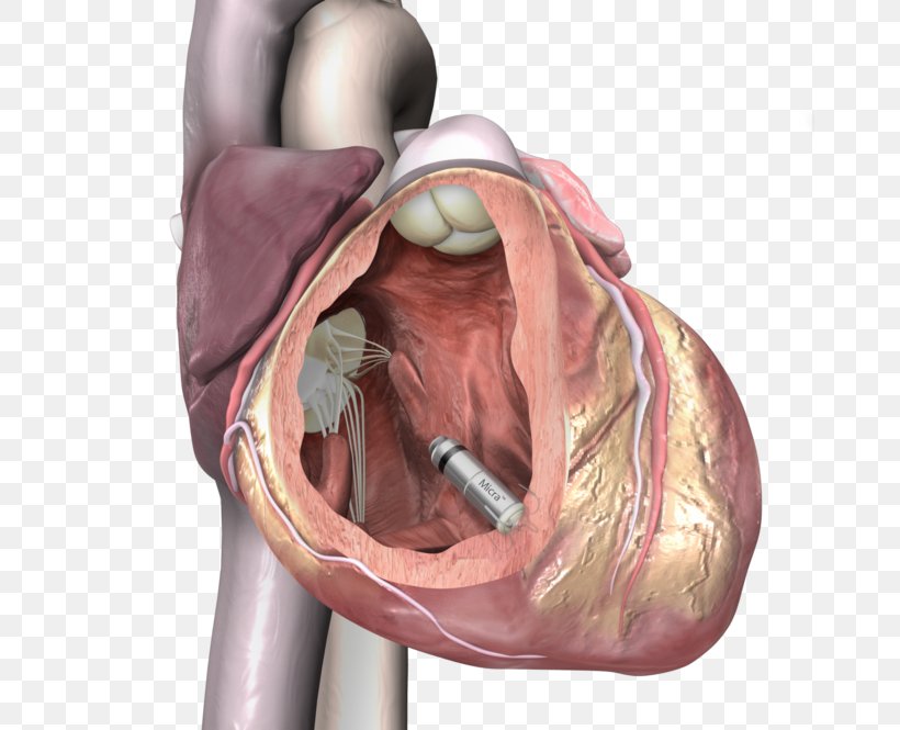 Artificial Cardiac Pacemaker Medtronic Implantable Cardioverter-defibrillator Cardiology, PNG, 665x665px, Watercolor, Cartoon, Flower, Frame, Heart Download Free