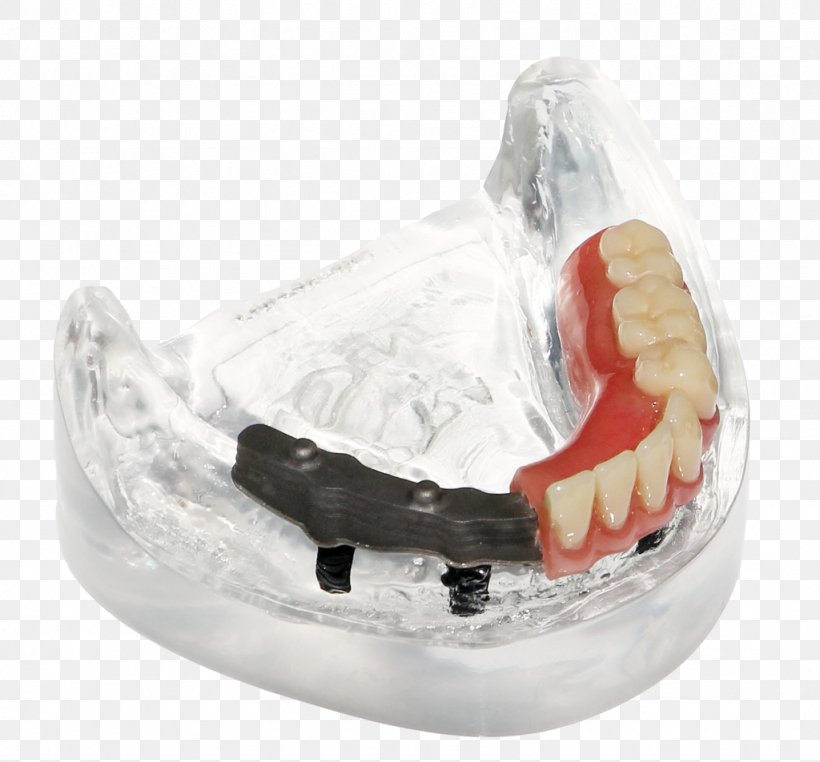 Dentures Prosthesis Tooth Bar Dentistry, PNG, 1024x952px, Dentures, Architectural Engineering, Bar, Dental Technician, Dentistry Download Free