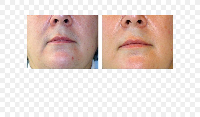 Lip Fotoepilazione Intense Pulsed Light Laser Hair Removal, PNG, 600x480px, Lip, Cheek, Chin, Close Up, Electrolysis Download Free