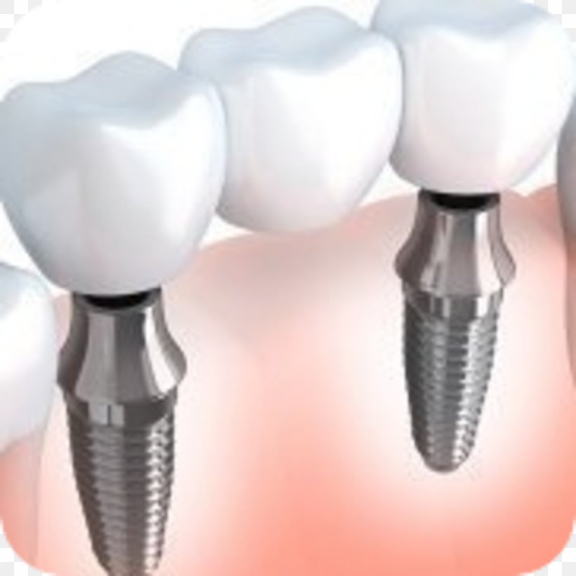 Dental Implant Bridge Dentistry Dentures, PNG, 1024x1024px, Dental Implant, Bridge, Cosmetic Dentistry, Crown, Dental Extraction Download Free