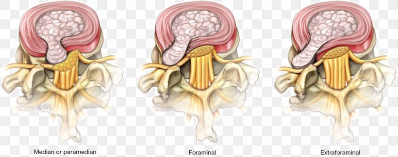 Lumbar Disc Herniation Spinal Disc Herniation Surgery Lumbar Disc Disease Discectomy, PNG, 1028x407px, Watercolor, Cartoon, Flower, Frame, Heart Download Free