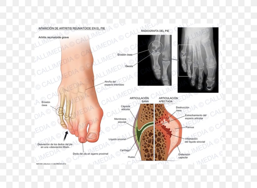Rheumatoid Arthritis Foot Thumb Rheumatology, PNG, 600x600px, Watercolor, Cartoon, Flower, Frame, Heart Download Free