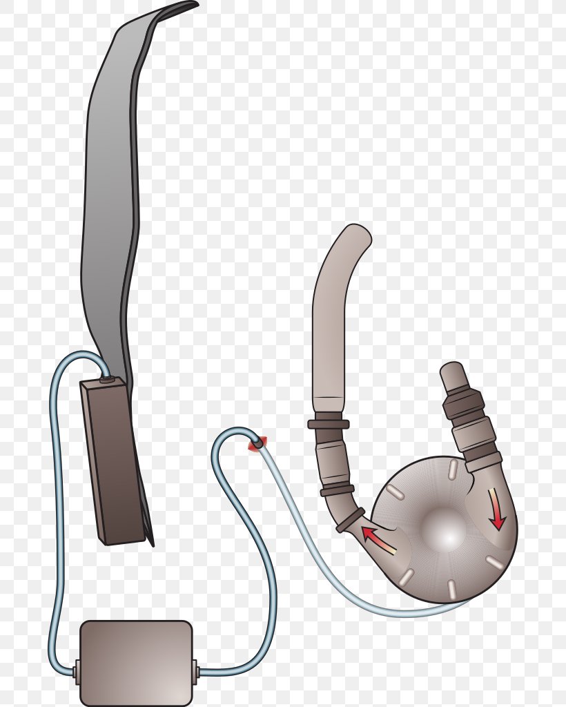 Ventricular Assist Device Ventricle Artificial Heart Implant, PNG, 682x1024px, Ventricular Assist Device, Aorta, Artificial Cardiac Pacemaker, Artificial Heart, Audio Download Free