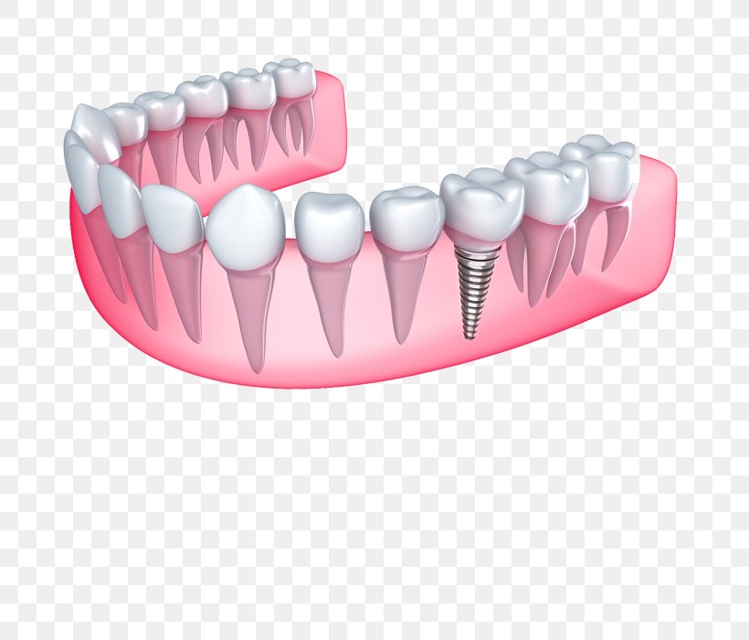 Dental Implant Cosmetic Dentistry Bridge, PNG, 700x700px, Dental Implant, Bridge, Brush, Clear Aligners, Cosmetic Dentistry Download Free