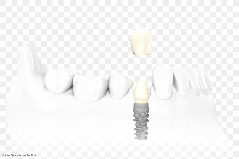 Dental Implant Dentistry Dental Surgery Crown, PNG, 5000x3333px, Dental Implant, Abutment, Bridge, Crown, Dental Surgery Download Free