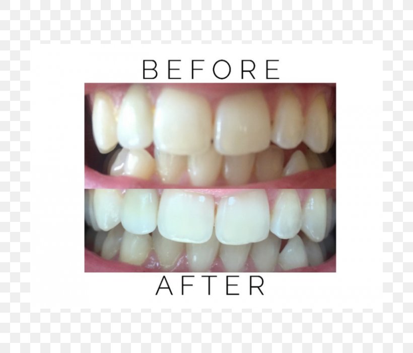 Oil Pulling Tooth Whitening Coconut Oil, PNG, 700x700px, Oil Pulling, Ayurveda, Coconut, Coconut Oil, Cosmetic Dentistry Download Free