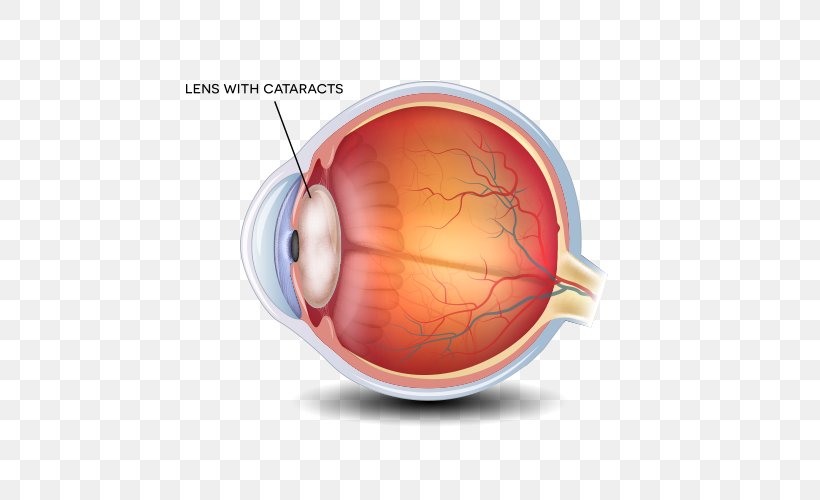 Cataract Surgery Ophthalmology Lens Eye Care Professional, PNG, 500x500px, Cataract, Blurred Vision, Cataract Surgery, Diabetic Retinopathy, Dry Eye Syndrome Download Free