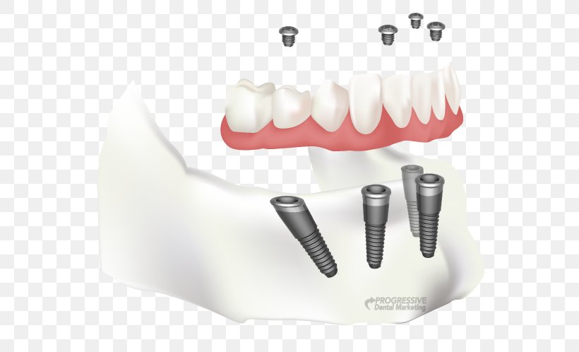 Tooth Dental Implant Dentistry All-on-4, PNG, 600x498px, Tooth, Dental Implant, Dental Restoration, Dental Surgery, Dentist Download Free