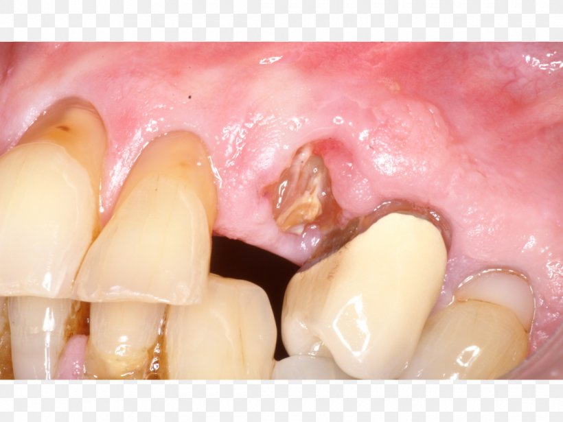 Well Drilling Tooth Directional Drilling As Osteotomy, PNG, 1120x840px, Well Drilling, Cosmetic Dentistry, Dentistry, Directional Drilling, Finger Download Free